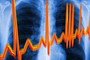 Širdies aritmija osteochondrozei